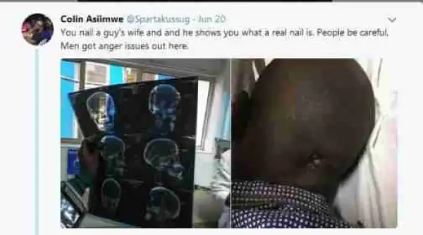 Kenyan Husband Catches Man On Top Of His Wife, Drives Nails Into His Head (Graphic)